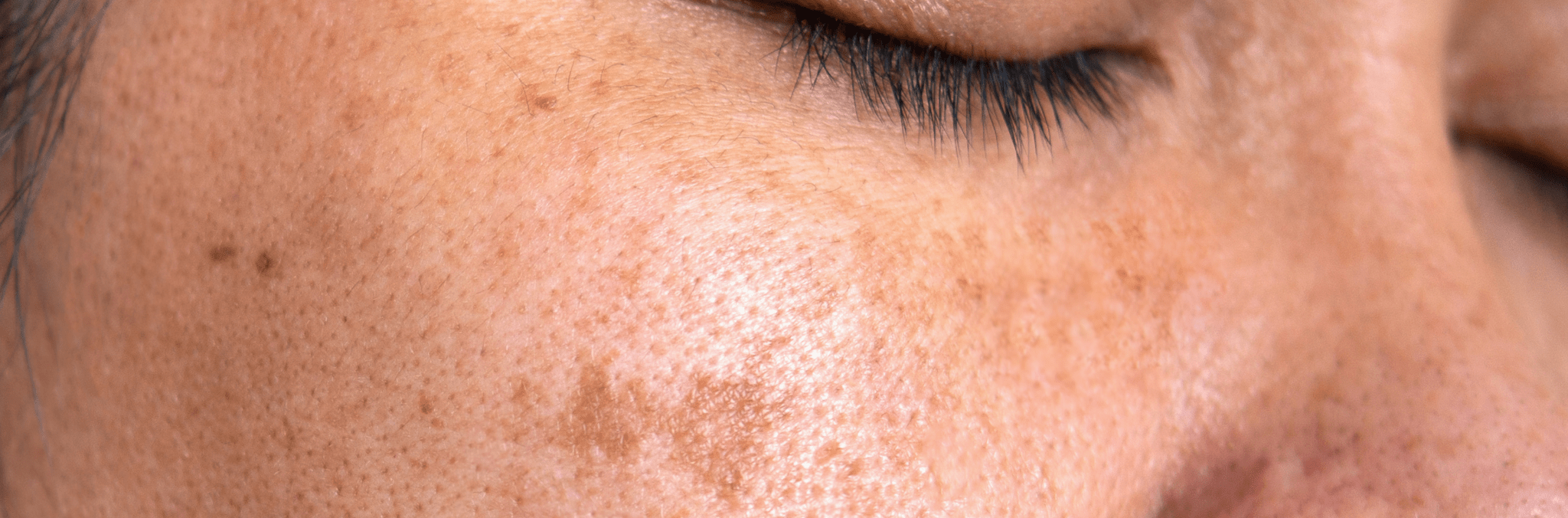 Why do dark spots surface as we age? - cocokind