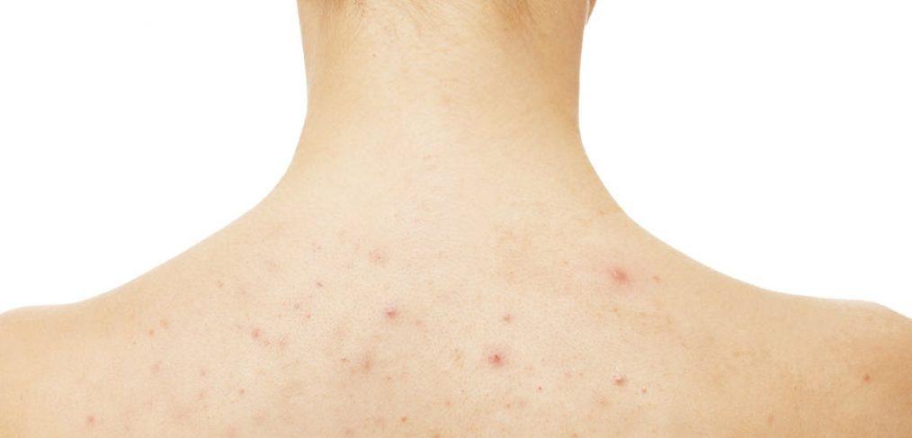 All About Body Acne – How It’s Different Than Face Acne And How To Treat It - cocokind