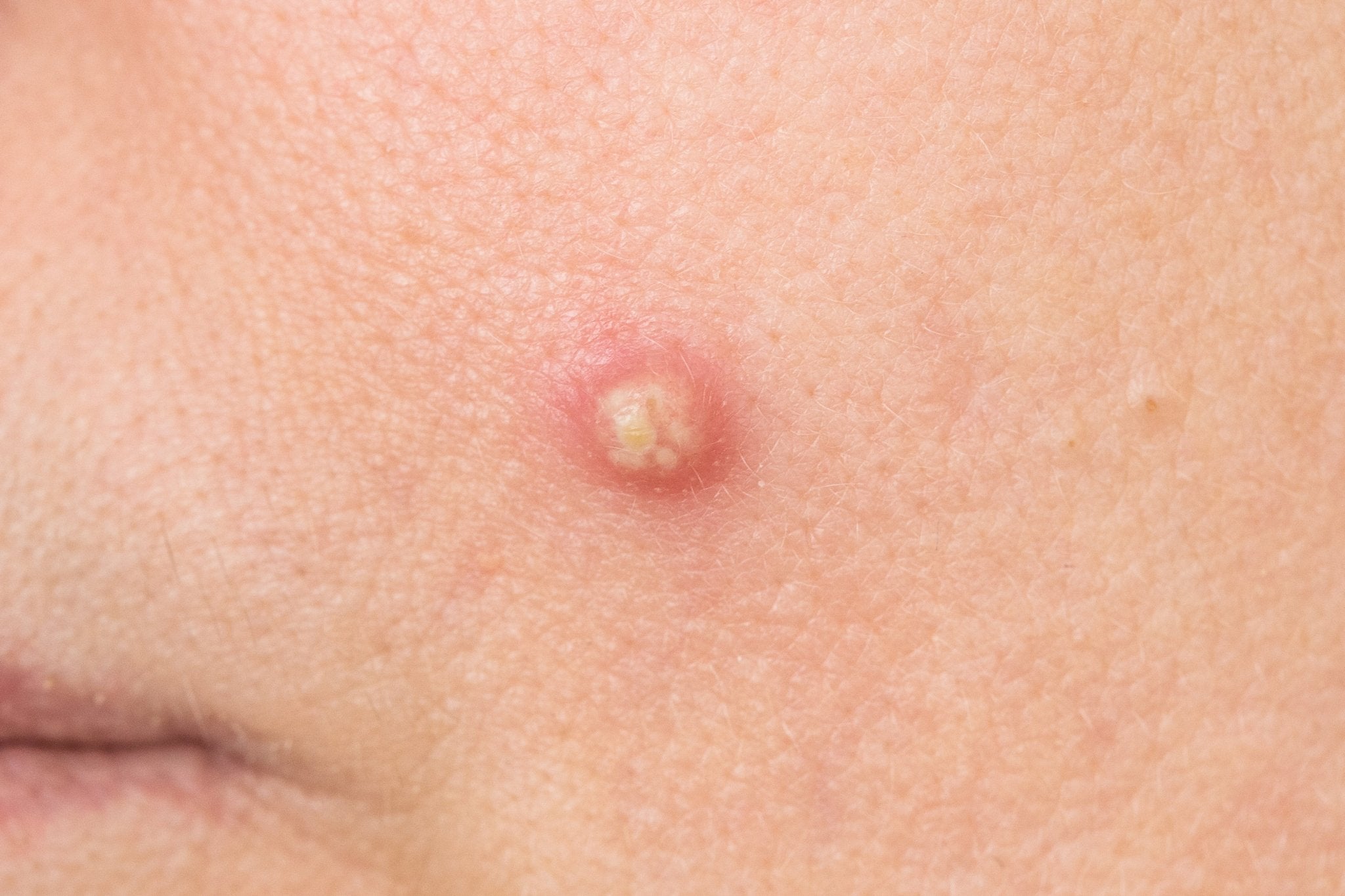 Zit Staking every type of zit, explained – cocokind