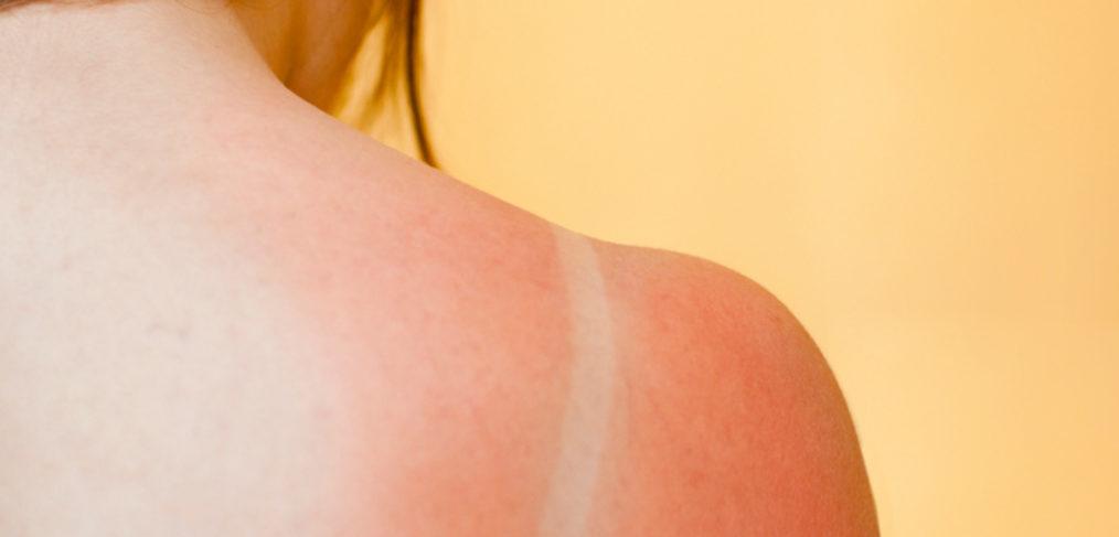 how to: soothe your sunburn - cocokind