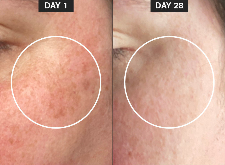 hyperpigmentation results